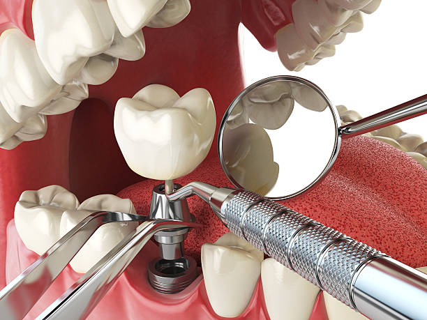Best Urgent Care for Lost Fillings or Crowns in Crump, TN