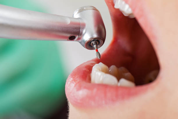Best Emergency Wisdom Teeth Removal in Crump, TN